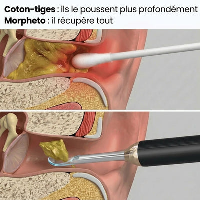 Morpheto - Clear Ear™