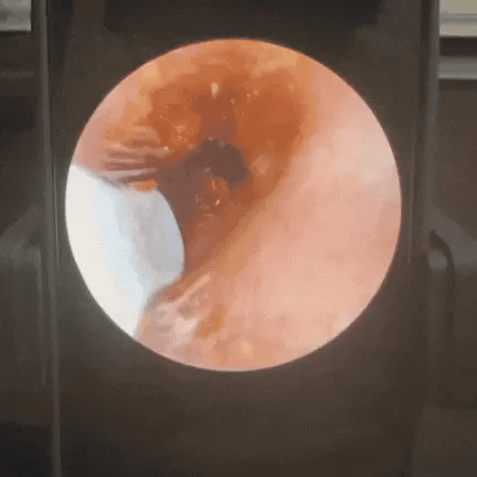 Morpheto - Clear Ear™